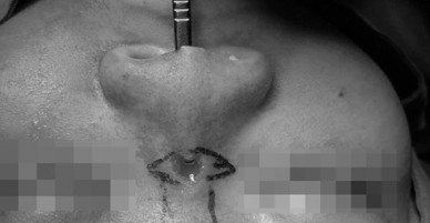 Thủng sống mũi sau 2 tháng làm đẹp ở spa rởm