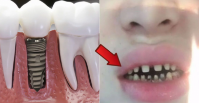 Tan giấc mộng làm răng sứ