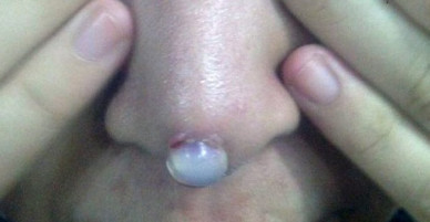 Thêm một cô gái đi phẫu thuật nâng mũi nhưng tham rẻ nên nhận hậu quả đau đớn, rách mũi để lộ cả silicon