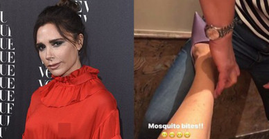 Đã hớ hênh nhũ hoa, Victoria Beckham còn không ngại khoe đôi chân mẩn đỏ vì muỗi cắn