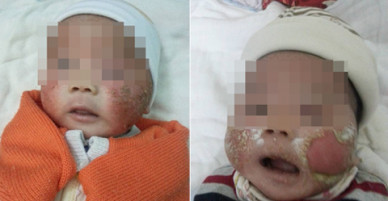 Mẹ tắm các loại lá cây khiến mặt con 3 tháng tuổi bị viêm, bong tróc
