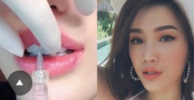 Lộ ảnh được cho là Bảo Thy đi tiêm môi căng mọng, khác hẳn ngoại hình trong quá khứ
