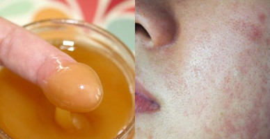 Thoa mật ong lên mặt mà mắc phải 5 sai lầm này thì dùng 1 xấu 10, da ngày càng sần sùi, đầy mụn