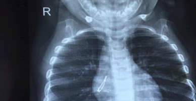 Con ho dai dẳng, sốt mãi không hạ, nhìn kết quả chụp phim phổi, bố mẹ sợ hãi khi thấy dị vật bên trong