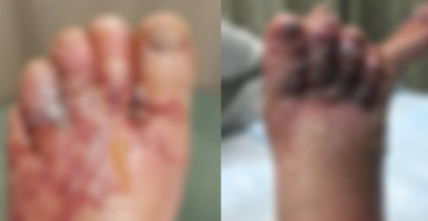 Đi chân trần trên biển, cặp vợ chồng kinh hãi khi thấy đôi chân sưng phồng, chuyển màu đen tím