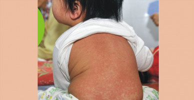 Dịch sởi “lăm le” bùng phát