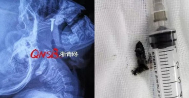 Con trai kêu đau ở mũi, cứ nghĩ con chỉ bị viêm nhẹ cho đến khi xem phim chụp X-quang, bà mẹ mới hoảng sợ bật khóc