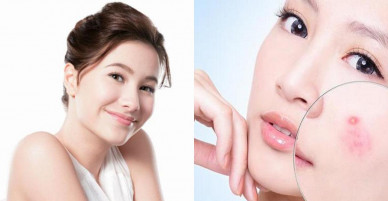 Trị mụn ẩn dưới da siêu hiệu quả từ những bí quyết thần thánh sau