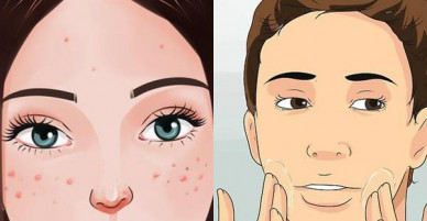 Dùng đủ cách để trị mụn cho da dầu nhưng mãi không dứt, chắc chắn bạn đã mắc phải 3 điều này
