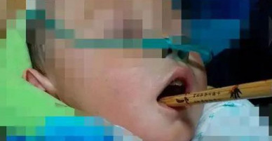 Cầm đũa đùa chơi không may vấp ngã, bé trai 1 tuổi bị chấn thương nội sọ, sức khỏe nguy kịch