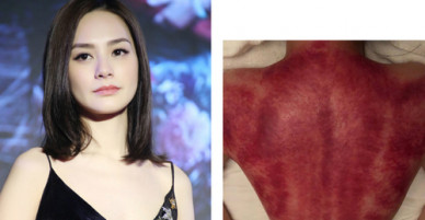 Chung Hân Đồng để lộ tấm lưng bầm máu