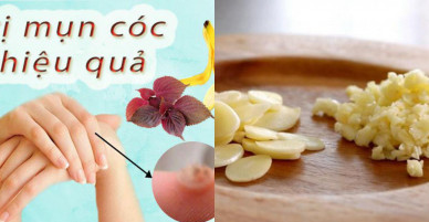 Bất ngờ với các cách trị mụn cóc ở chân tại nhà, khiến mụn “một đi không trở lại”!