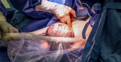 Hiếm thấy trong 80.000 ca sinh: bé gái chào đời với màng ối trùm quanh đầu
