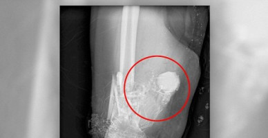 Bác sĩ gọi đội phá bom để gỡ pháo trong chân bệnh nhân