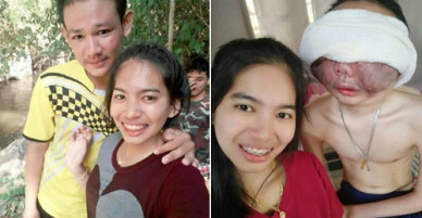 Cô gái 3 năm ở bên chăm sóc bạn trai bị ung thư biến dạng mặt