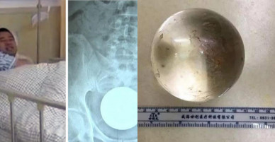 Nhét quả bóng 7cm vào hậu môn, không tài nào lấy ra được