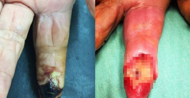TP.HCM: Bị gai tôm đâm, cụ bà 80 tuổi suýt mất ngón tay vì hoại tử