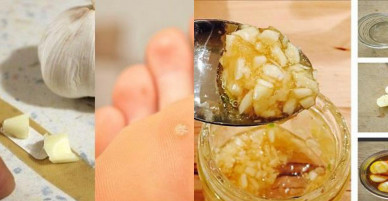 Đắp 3 “thần dược” này mỗi ngày, bạn sẽ không bao giờ biết đến mụn cóc ở chân là gì!