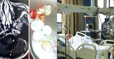 Buồn nôn đến viện khám, không ngờ phát hiện 30 trứng sán dây trong đầu