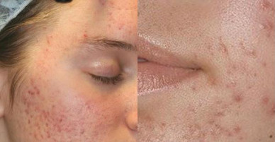 Da mụn thâm đỏ chi chít cũng giảm sưng hơn chỉ trong vài bước