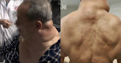 Uống rượu 1 lít/ngày, người đàn ông nhìn như ‘quái vật’ thế này