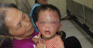Bé trai 2 tuổi bị bố dượng đánh bầm tím mặt