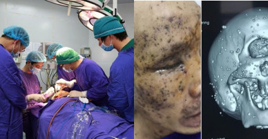 Gắp hơn 100 dị vật li ti găm vào vùng hàm mặt bệnh nhân