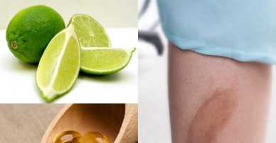 4 cách trị sẹo thâm ở chân nhanh nhất giúp nàng tự tin mặc váy xuống phố!