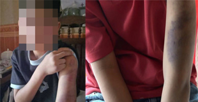Bé trai nghi bị bố và mẹ kế đánh bầm tím khắp người