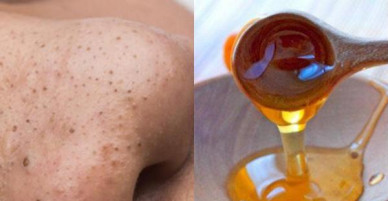 Không phải ai cũng biết cách trị mụn đầu đen ngay tại nhà bằng phương pháp này!