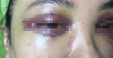 Khách hàng tố bệnh viện gây biến chứng sau khi phẫu thuật thẩm mỹ