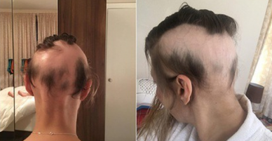 Chị em làm đám cưới đừng lo lắng quá, người phụ nữ này đã rụng sạch tóc vì căng thẳng chuẩn bị cho ngày trọng đại