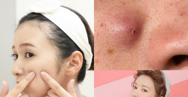 Chị em chớ dại mà nặn những loại mụn này nếu không muốn bị nhiễm trùng máu, nguy hiểm tính mạng