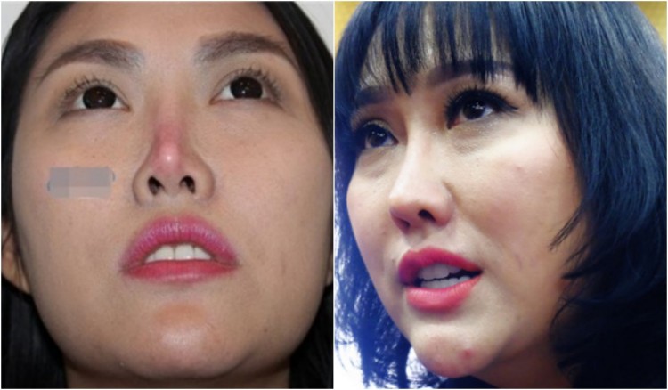 sao Việt, phẫu thuật thẩm mỹ, hư hỏng, hoại tử, khác lạ, công nghệ thẩm mỹ, thú nhận, ngoại hình, tin8